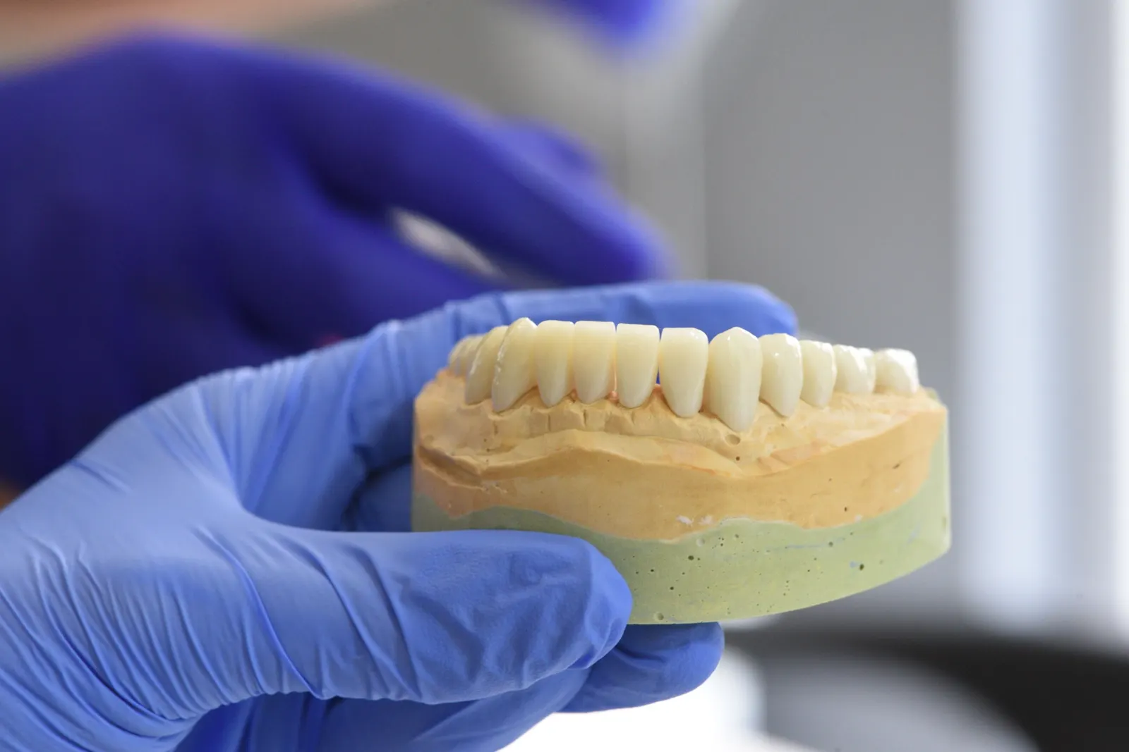 Una arcada inferior de coronas terminadas sobre su modelo de yeso, sostenida con guantes